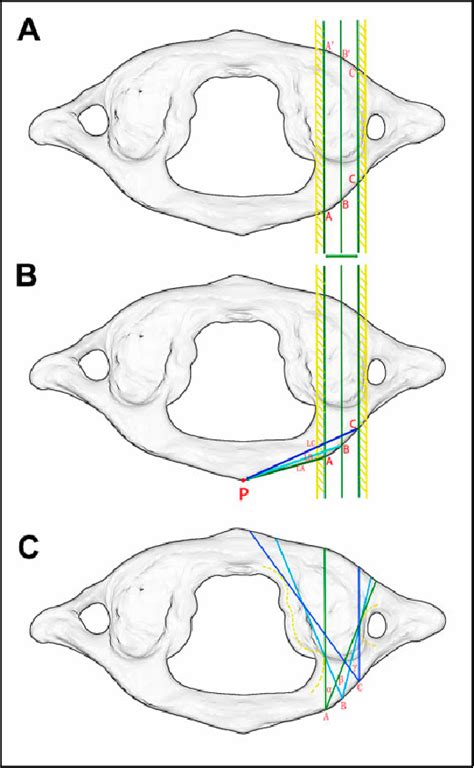 Figure 1 From Feasibility Of Atlas Pedicle Screw Fixation Perpendicular