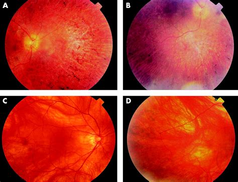 Dominant Retinitis Pigmentosa Phenotype Associated With A New Mutation