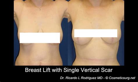 Boob Lift Scars Telegraph