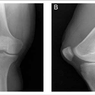 Anteroposterior Ap A And Lateral B Radiographs Of The Right Knee