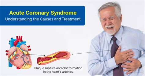 Acute Coronary Syndrome (ACS): Types, Symptoms and Treatment