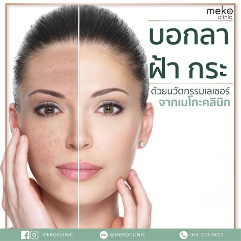 วิธีรักษาและป้องกัน ฝ้ากระจุดด่างดำ ให้กระจ่างใสสวยธรรมชาติ Meko Clinic