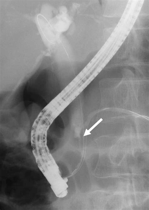 Ercp Revealed Irregular Stricture Of The Distal Cbd Arrow Brush Download Scientific Diagram