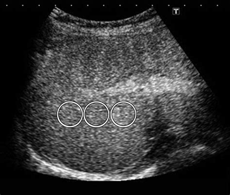 Contrast Enhanced Ultrasound With Perflubutane Microbubble Agent Evaluation Of Differentiation