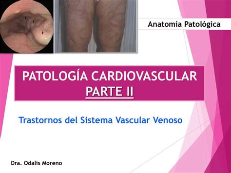 Patología Cardiovascular PARTE II Anatomía Patológica Dra