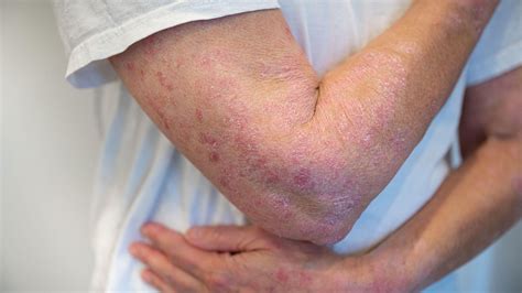 Aad Psoriasis News Spotlight On Medpage Today