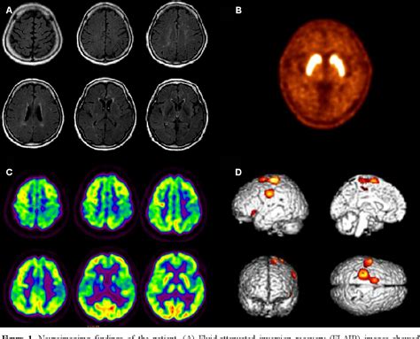 Figure 1 From Corticobasal Syndrome Initially Presenting With Apraxia Of Speech Semantic Scholar