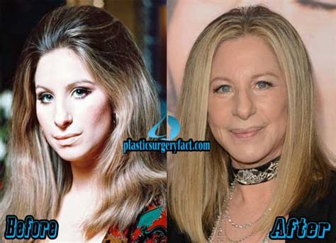 Barbra Streisand Plastic Surgery Before And After Pictures Plastic