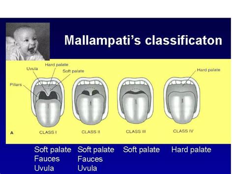 Airway Assessment In Paediatrics Patients Laryngoscopy Intubation Ppt