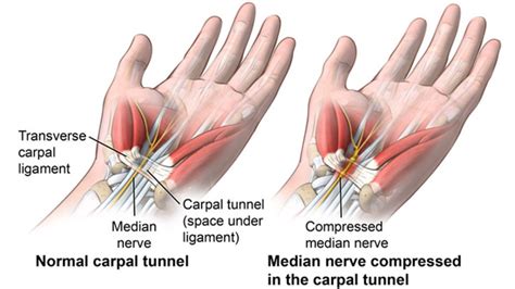 Carpal Tunnel Syndrome Osteopathy Prescriptive Exercise By Osteopath