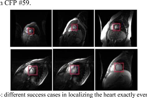 Figure 2 From Automatic Localization Of The Left Ventricle In Cardiac