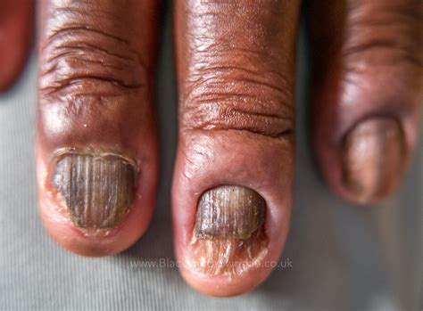 Lichen Planus Nailsonychomycosis — Black And Brown Skin