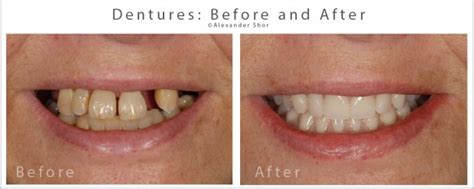 9 Dentures Before And After Pictures FerlinGeorgina