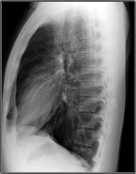 Clinical Anatomy | Radiology | Lateral Mediastinum