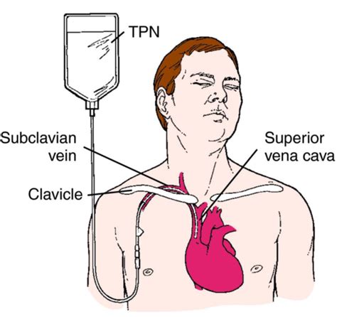 Enteral And Parenteral Feeding Flashcards Quizlet