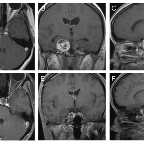 The Preoperative And Postoperative MRI Imaging Of Case 1 A C