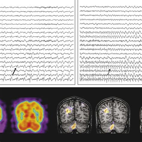 Ictal EEG and SISCOM. The patient's gelastic seizure (arrow) was ...