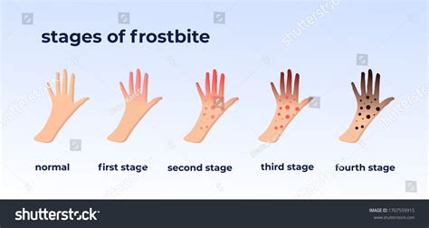 Frostbite Hand Over 259 Royalty Free Licensable Stock Vectors And Vector