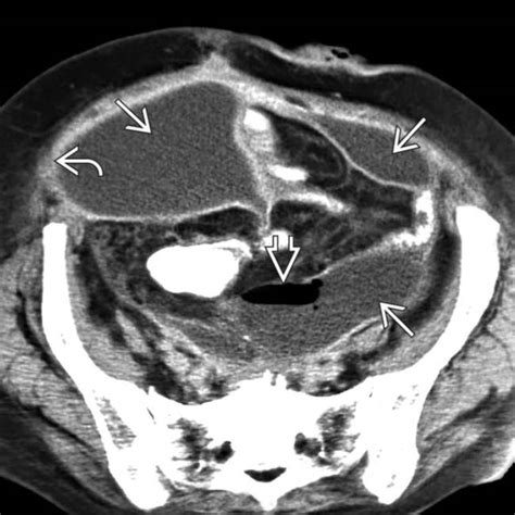 Abdominal Abscess | Clinical Gate