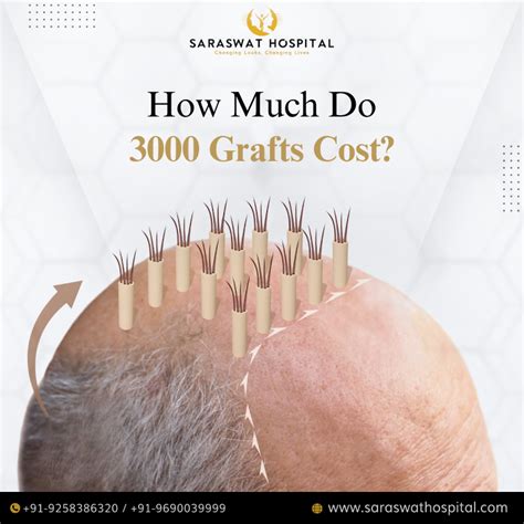 What Is The Cost Of Implanting 3000 Grafts In Hair Transplant