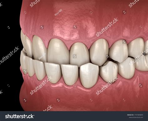 Underbite Dental Occlusion Malocclusion Teeth Medically Stock