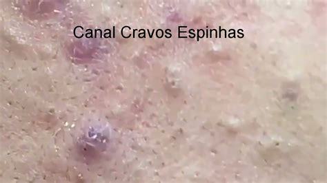 Espremendo Cravos E Espinhas Gigantes Removendo Cravos Youtube