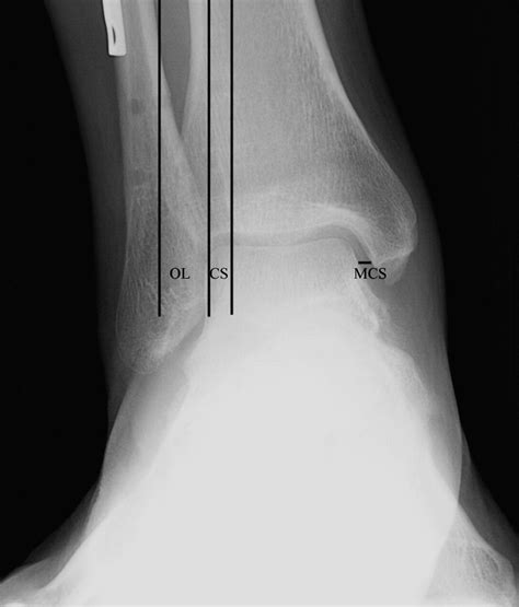 The Radiographic Fate Of The Syndesmosis After Trans Syndesmotic Screw