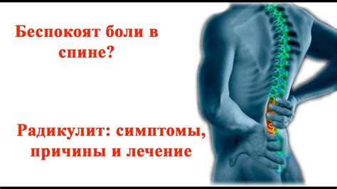Беспокоят Боли в Спине? Радикулит: Симптомы, Причины, Лечение - YouTube