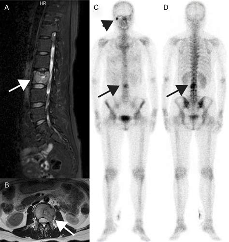 Solitary Fibrous Tumor Of The Bone Detected By Fdg Pet Ct Clinical