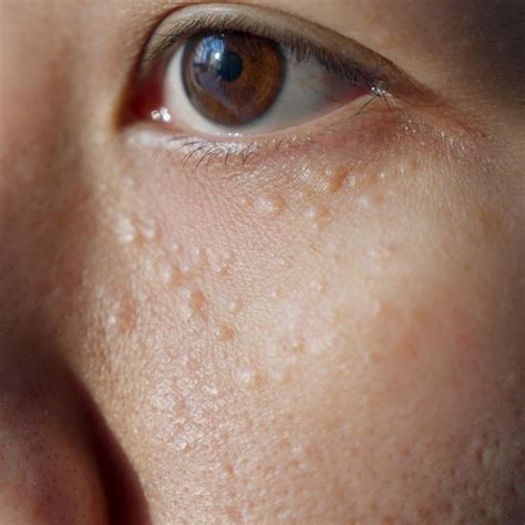 Milia — Fora Dermatology - General & Surgical Dermatology in ...