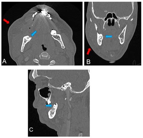 Reports Free Full Text Facial Cellulitis Of Unusual Odontogenic Origin