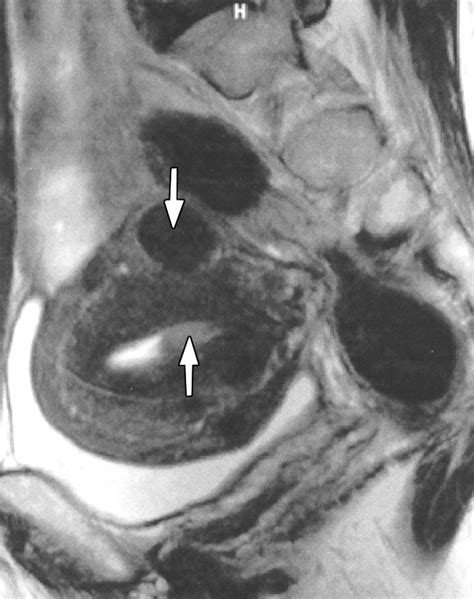 Fast Breath Hold T2 Weighted MR Imaging Reduces Interobserver