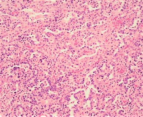 Papillary Serous Cystadenocarcinoma Left Ovary He Staining Of Download Scientific Diagram