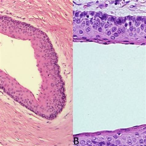 A The Connective Tissue Shows Mild Infiltration Of Inflammatory Cells