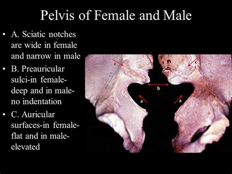 Difference B W Male And Female Pelvis 02 Preauricular Sulcus In Females