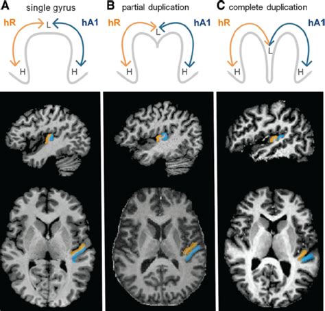 Heschls Gyrus Variants Are Part Of A Continuum Rather Than Distinct