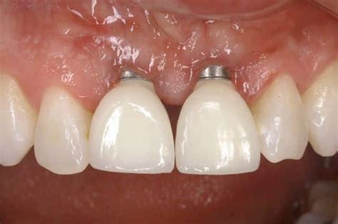 Implantes Dentales de ZIRCONIO Cerámica Solución Dental