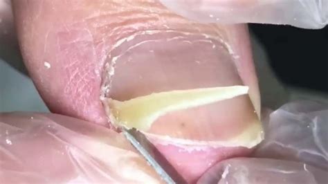 The Complete Trimming Process For A Huge White Ingrown Toenail YouTube