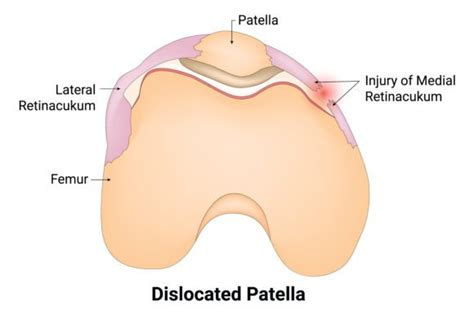 Dislocated Patella Science Design Vector Graphic by hamjaiu · Creative ...