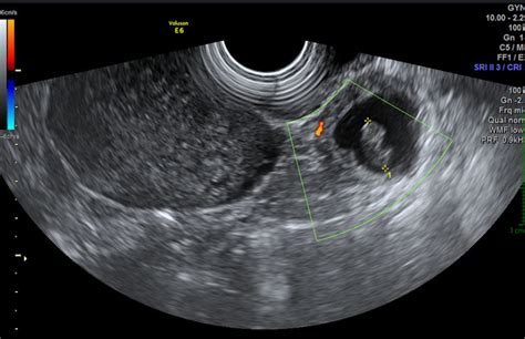 Radiologia Brasileira Gravidez Ect Pica Ensaio Iconogr Fico