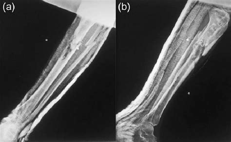 Anteroposterior A And Lateral B Radiographs Of The Left Tibia And