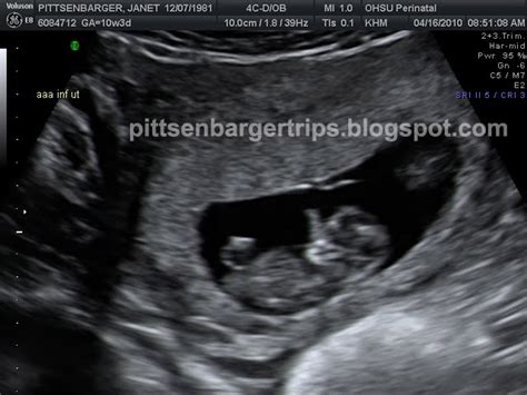 PITTS TRIP'S: the Pittsenbarger identical triplets saga: 10 week ultrasound