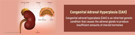 Congenital Adrenal Hyperplasia Cah Causes Symptoms Diagnosis And Treatment