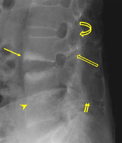 Ankylosing Spondylitis Spine X Ray