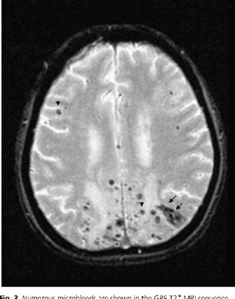 Figure From Cerebral Amyloid Angiopathy In East And West Semantic