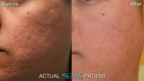 June 2013 Laser Acne Scar Resurfacing Male Olive Skin Tone Youtube