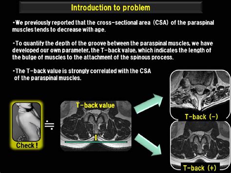 Figure 1 from Comparison of MRI features of psoas muscles in patients ...