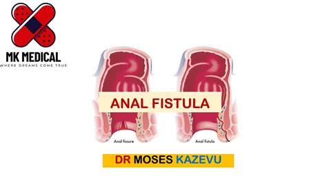 Anal Fistula YouTube