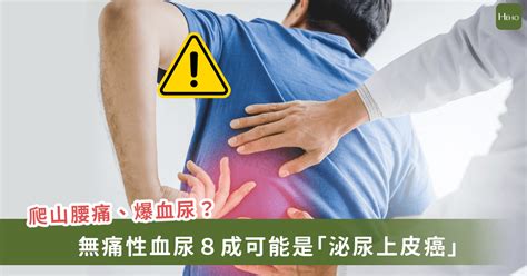 爬山太累腰痛、爆血尿當心罹患泌尿上皮癌！醫：台灣發生率較他國高4至5倍 Heho Cancer