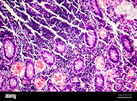 L Ad Nocarcinome Peu Diff Renci De La Lumi Re Intestinale